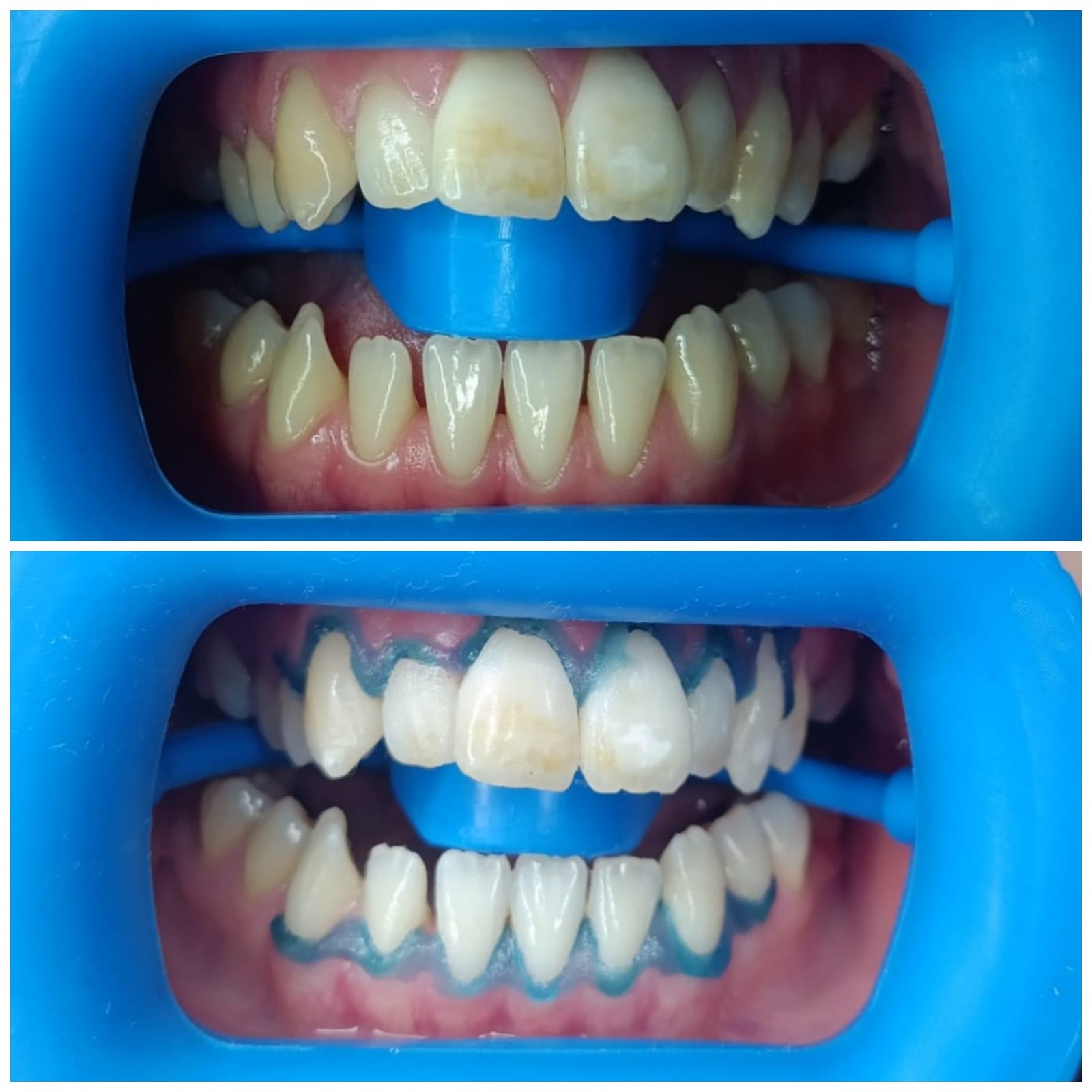 Before and After Laser Hair Removal