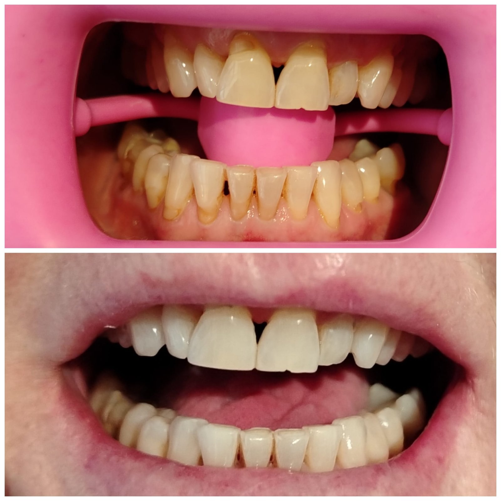 After Laser Hair Removal