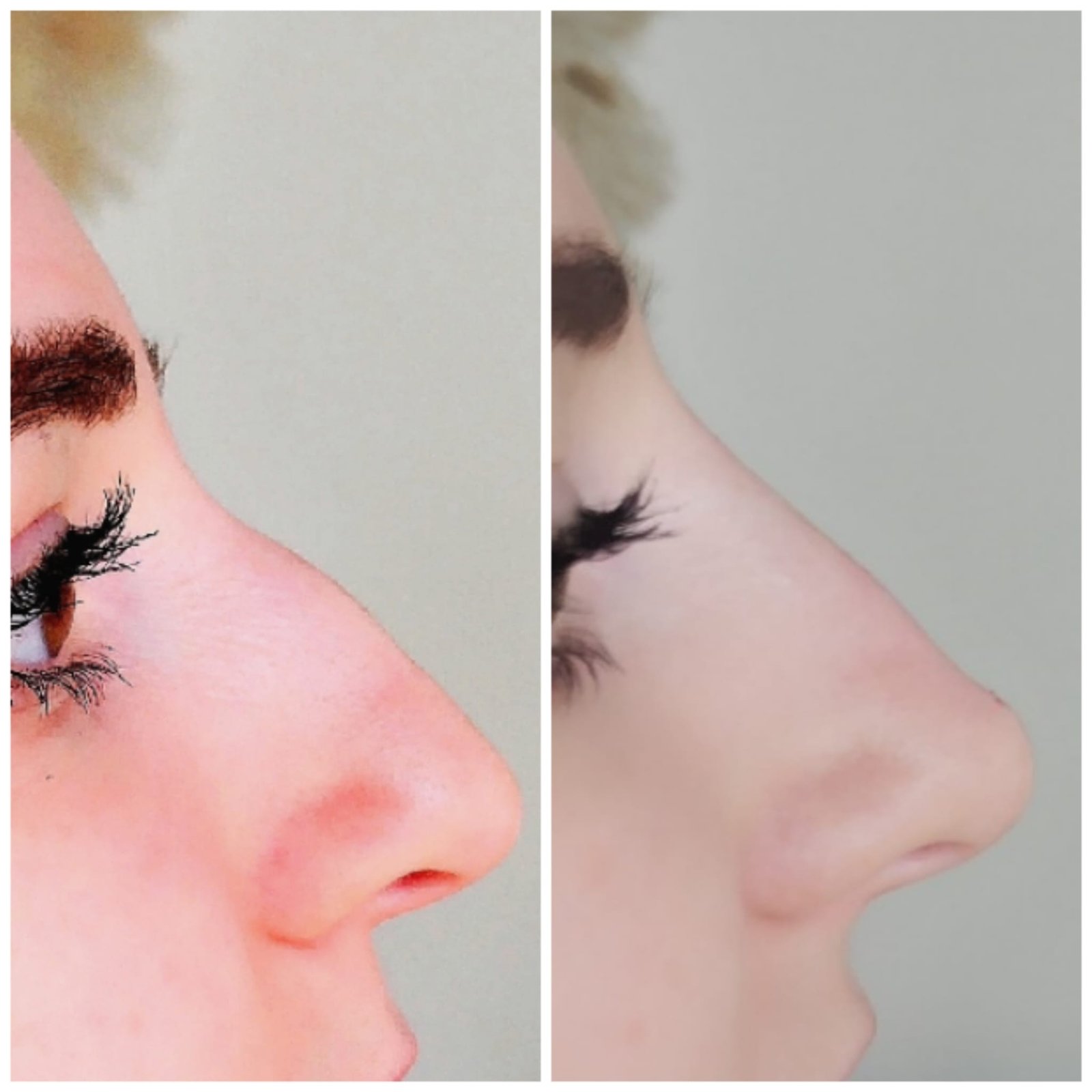 Before and After Non-Surgical Rhinoplasty