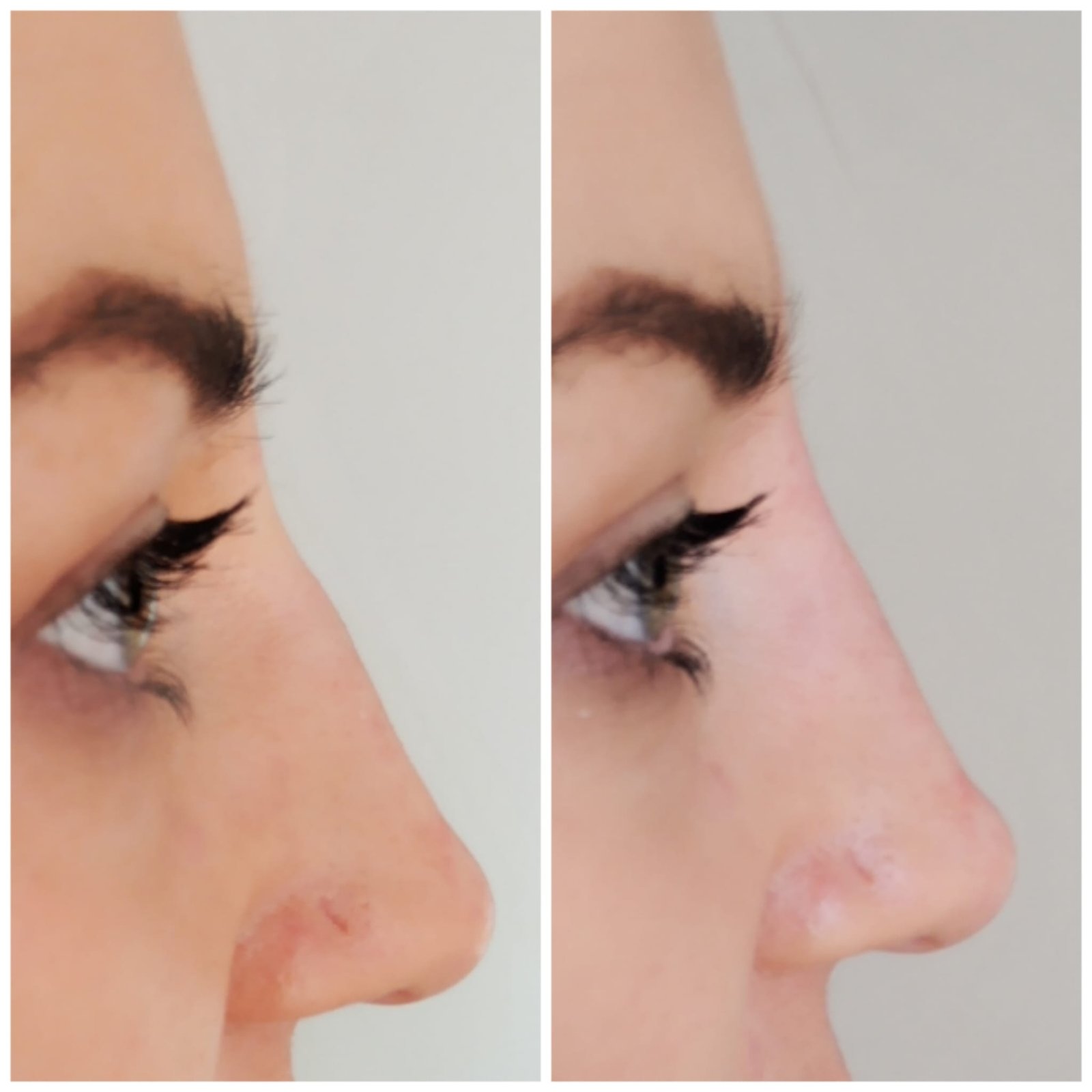 After Non-Surgical Rhinoplasty
