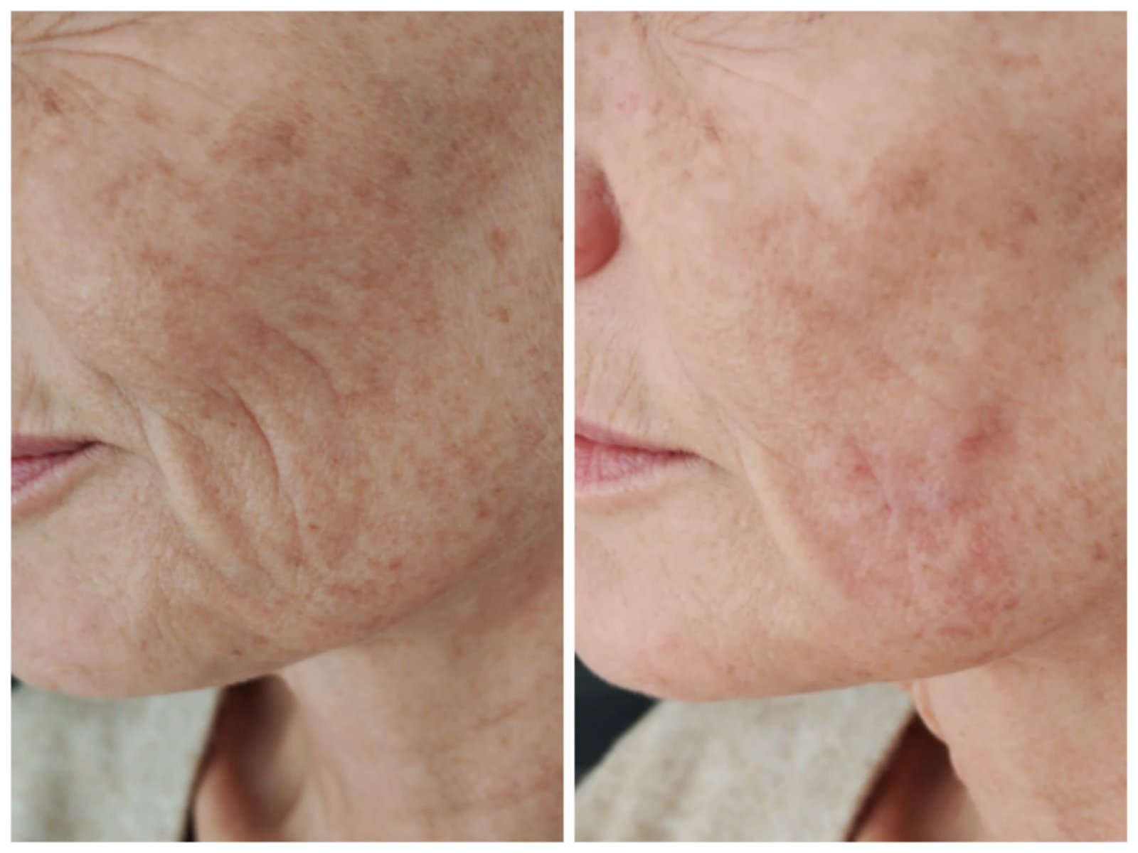 Before and After Anti-Wrinkle Injections