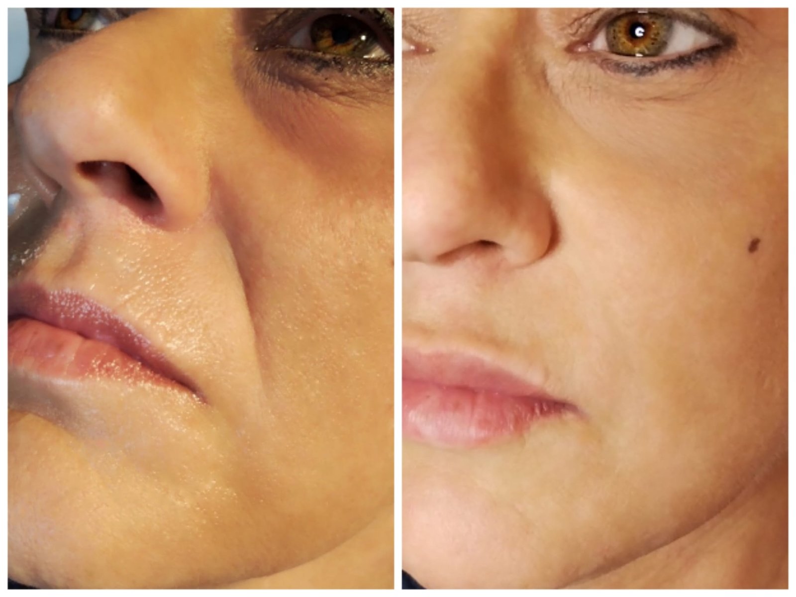 After Anti-Wrinkle Injections