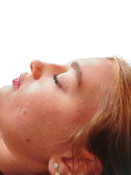 Non Surgical Rhinoplasty